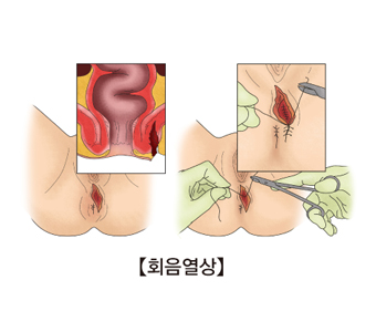 회음 열상