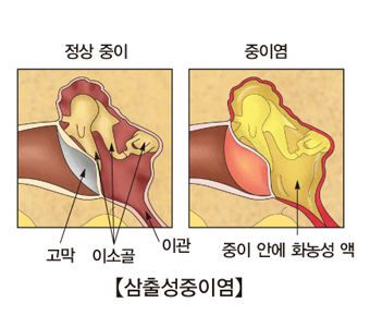 중이염